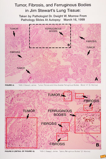 Tumor Fibrosis